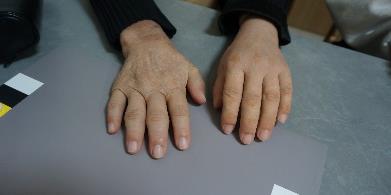 부분 손 의수 착용 후