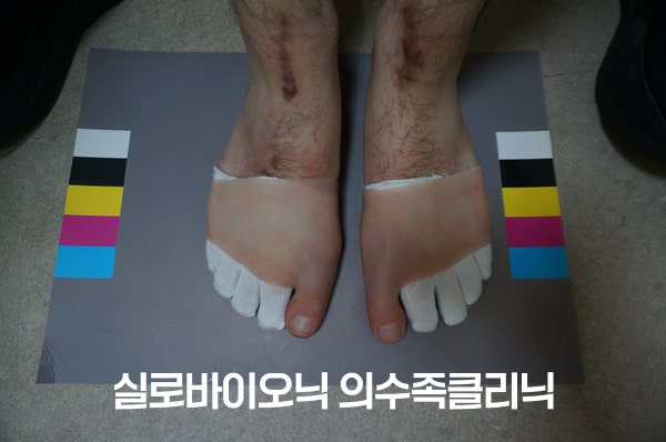 발가락 양말 위에 실리콘 엄지발가락 의족을 착용한 두 발