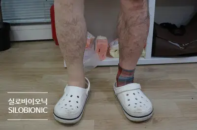 실리콘 방수커버를 씌운 하퇴 의족을 신고 선 모습