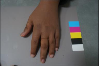 After: full silicone finger prostheses