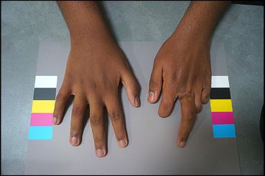 Before: hand with partial finger loss