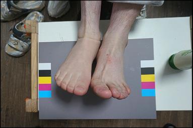 After: silicone partial foot prosthesis