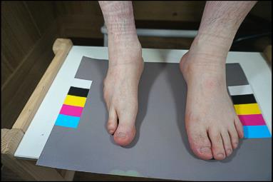 Before: partial foot amputation