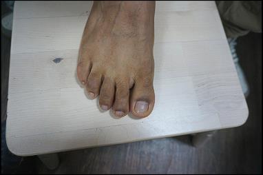 Before: missing toe