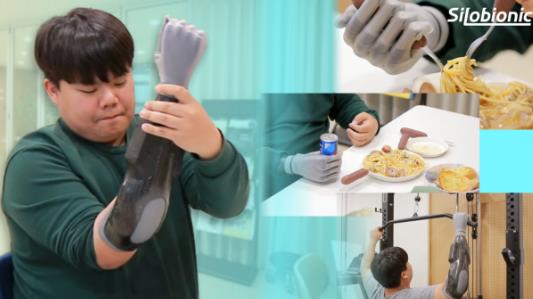 A customer using a myoelectric arm in daily life