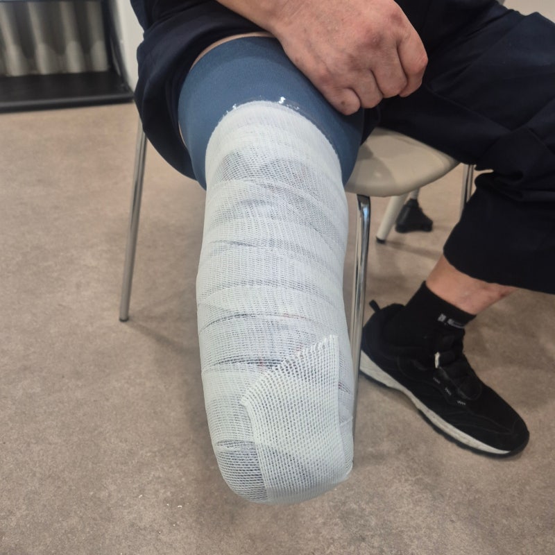 A below-knee residual limb wrapped in plaster bandage