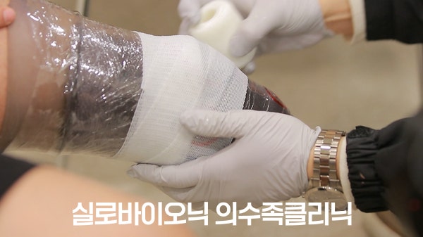 يدان بقفازين تأخذان قالبًا للطرف المتبقي