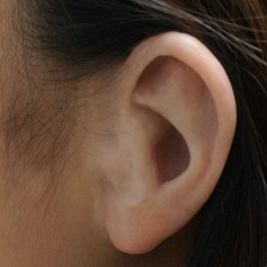 Silicone ear prosthesis